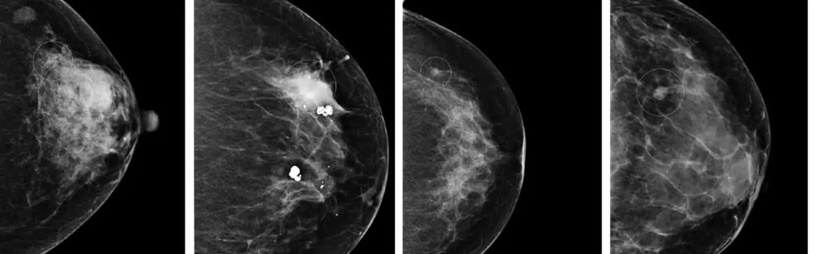 What Is The Role Of Mammography In Cancer?